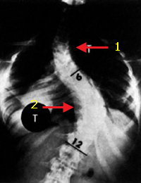 Scoliosis Scoliosis (3).gif
